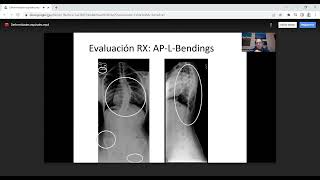 DEFORMIDADES ESPINALES EN LA INFANCIA Y ADOLESCENCIA [upl. by Agiaf]