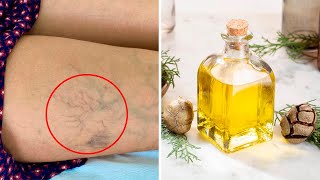 How to Get Rid of Varicose Veins With Essential Oils [upl. by Aenehs]