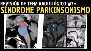 Revisión de Tema Radiológico 34 Síndrome Parkinsonismo [upl. by Dagley]