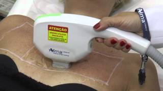 Tratamento com DYE VL  Alma Lasers [upl. by Aney559]