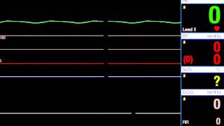 Asystole [upl. by Mitzie]