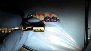 Tooth Stain Removal  Opalustre Part 2 [upl. by Ambros]