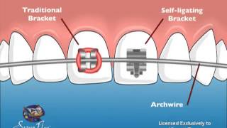 Vincent Team Orthodontics SelfLigating Braces [upl. by Lesley15]