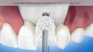 Formazione di osso intorno ad un impianto dentale  Geistlich Biomaterials [upl. by Pachton67]