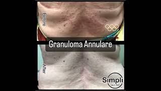 Granuloma Annulare [upl. by Stroup8]