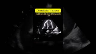 Diastolic RV Collapse is Highly Specific sign of Cardiac Tamponade echocardiography cardiology [upl. by Nnairam846]