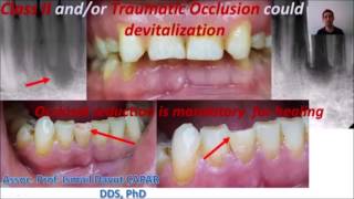 Endodontide Karşılaşılan Problemler ve Çözüm Yöntemleri 1 edit edilmiş [upl. by Namas671]