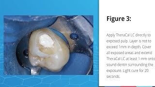 Direct Pulp Capping Case using TheraCal LC [upl. by Joscelin]