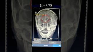 x ray pns  frontal sinus  radiology  youtubeshorts youtube viralvideo shorts radiology [upl. by Pierre904]