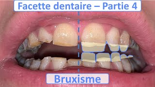 Facette dentaire et Bruxisme  Guide complet  Partie 4 [upl. by Embry]