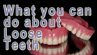 What can be done about loose teeth [upl. by Nagaem]