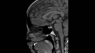 How to read an MRI of the pituitary gland  First Look MRI [upl. by Asit]