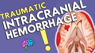 Intracranial Hemorrhage [upl. by Solracesoj]