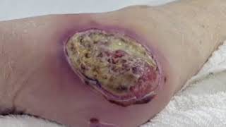 Wound Care Part 3 Types of Wounds [upl. by Roydd72]