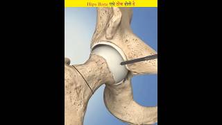 This is how damaged hip bone is repaired [upl. by Jacinto]