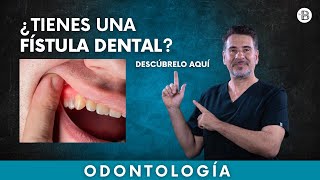 FÍSTULA DENTAL ¿Qué es y cómo eliminarla👈 [upl. by Parthinia]