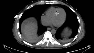 Hematoma with active extravasation [upl. by Rogergcam661]