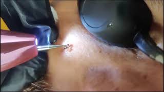 haw to mole removal treatment permanent solution all time [upl. by Wexler]