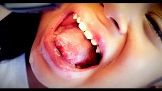 BAD TONGUE SORES Herpes Stomatitis  Dr Paul [upl. by Lacram915]