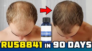 RU58841 Solo 90 Day Results  Newbie Explanation Of Topical AntiAndrogens For Hair Loss Prevention [upl. by Ronal]