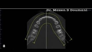 External Root Resorption with large lateral lesion  Dr Mazen D Doumani [upl. by Williamson455]