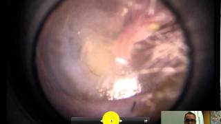 normal ear exam of the tympanic membrane [upl. by Aiekat112]