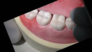 Crown Preparation for a Molar [upl. by Bourne]