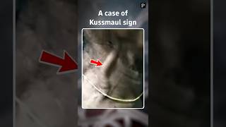 Case of Kussmauls sign [upl. by Afaw558]