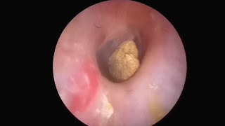 WOW SHOCKING EAR STONE REMOVAL PROCESS [upl. by Ynohtnad]