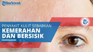 Dermatitis Seboroik Penyakit yang Menyebabkan Kulit Berwarna Merah Berketombe dan Bersisik [upl. by Akinom581]