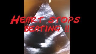 Cardiology Echo QuizCase Heart stops beating Part 1 SCD VT SVT AVRT AVNRT Sinus Tach [upl. by Schrader]