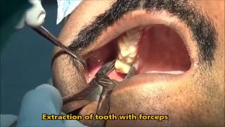 Upper wisdom tooth extraction with forceps [upl. by Irret201]