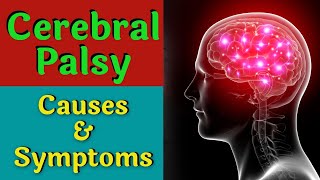 What is Cerebral Palsy Know its causes and symptoms [upl. by Jorgan]