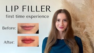 Getting Lip Filler for the First Time [upl. by Aitnas]