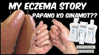 PAANO GAMOTIN ANG ECZEMA SUGAT SUGAT NA KAMAY 1 WEEK LANG [upl. by Anawed]