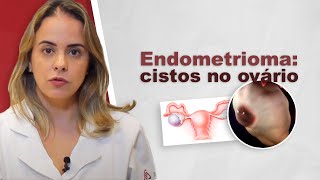 Endometrioma cistos de endometriose no ovário [upl. by Rosemari]