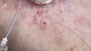 Big Cystic Acne Blackheads Extraction Blackheads amp Milia Whiteheads Removal Pimple Popping [upl. by Atsejam]