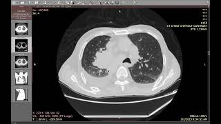 Case 5 situs inverses with bronchogenic cancer amp lymphangitis carcinomatosis [upl. by Ymeraj]