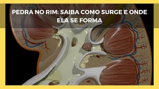 Pedra no Rim Como Surge e Onde Ela se Forma [upl. by Anthia]