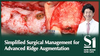 SUB S1  Simplified Surgical Management for Advanced Ridge Augmentation [upl. by Finnigan]