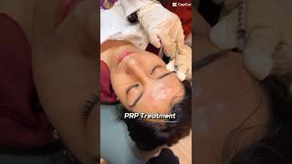 Face PRP Treatment acnescars skincare [upl. by Vladimar]