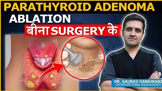 Parathyroid Adenoma Causes Symtoms and Treatment Dr Gaurav Gangwani Interventional Radiologist [upl. by Ly]