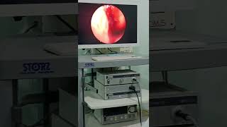 ENDOSCOPIC ETHMOID SINUS EXPLORATION maxillofacialsurgeon face surgeryrecovery youtubeshorts [upl. by Hadeehsar]