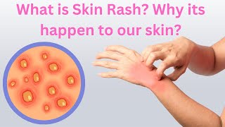 What is Skin Rash Why its happen to our skin  Med About You [upl. by Htebirol]