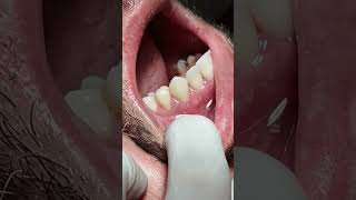 Tooth crowns after RCT satisfying [upl. by Nielsen]