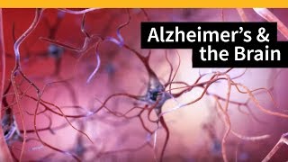 How Alzheimers Changes the Brain [upl. by Oirifrop]