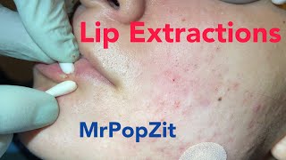 Lip extractions Whiteheads blackheads acne extractions on face Inflammatory pustules [upl. by Enialahs]