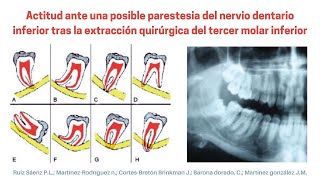 Posible PARESTESIA del NERVIO DENTARIO INFERIOR tras extracción quirúrgica del TERCER MOLAR INFERIOR [upl. by Pylle]