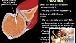 Lesions Of The Shoulder  HillSachs Lesion  Everything You Need To Know  Dr Nabil Ebraheim [upl. by Rammus]