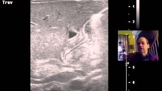 Pyloric Stenosis Ultrasound DISCUSSION 1 [upl. by Navets]